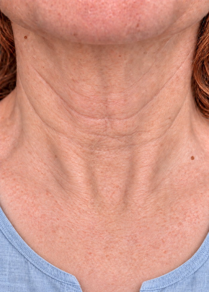 The same neck at week four