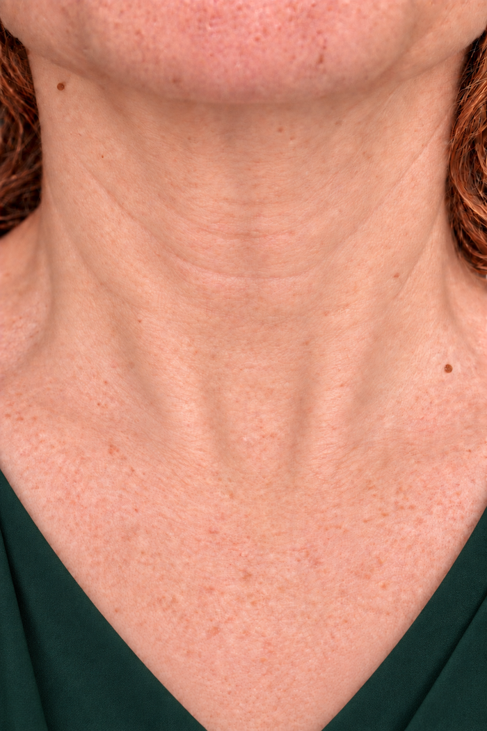 The same neck at week eight